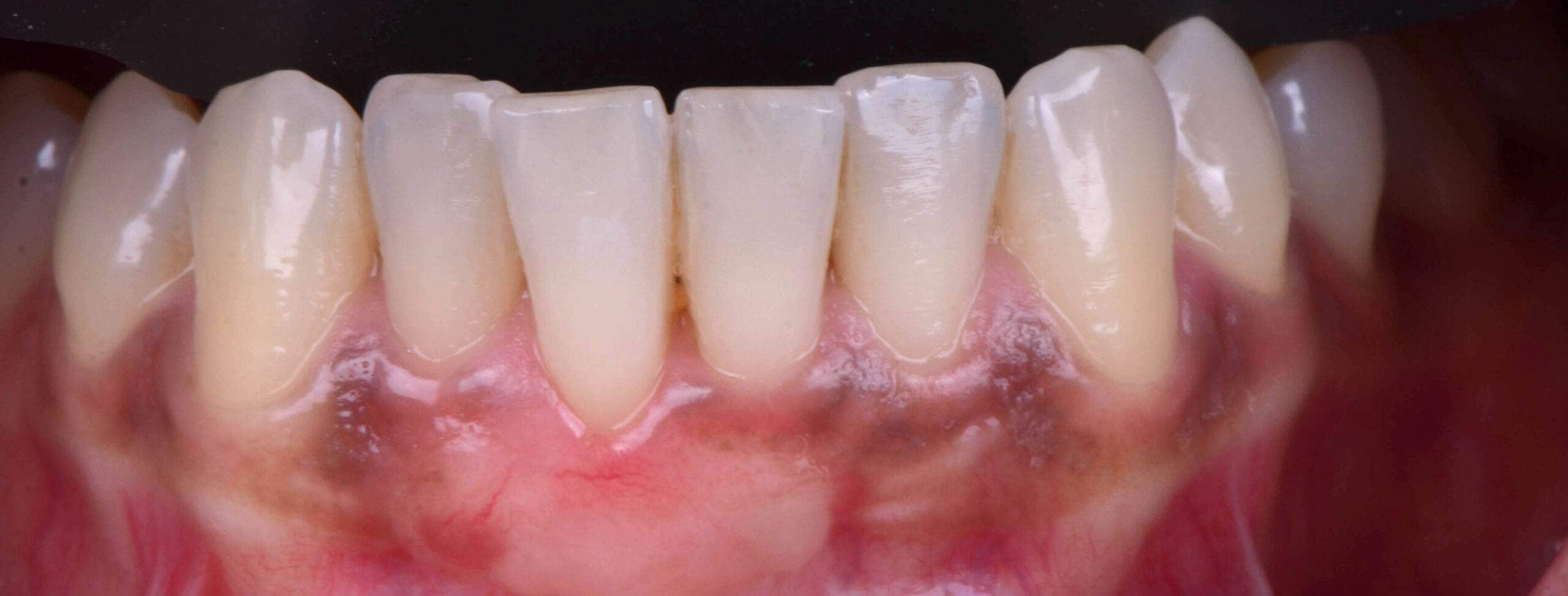 APRES - chirurgie parodontale - dr alex dagba dentiste paris