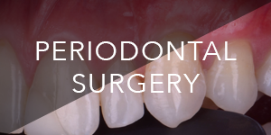 Periodontal surgery - dr alex dagba - dentist - paris