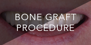bone graft procedure - dr alex dagba - dentiste paris