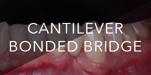cantilever bonded bridge - dr alex dagba - dentiste - paris