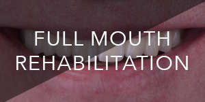 full mouth rehabilitation - dr alex dagba - dentiste paris
